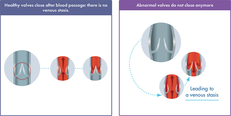 Chronic Venous Disease