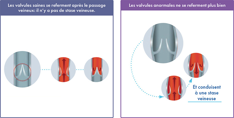 Qu'est-ce que la maladie veineuse chronique?