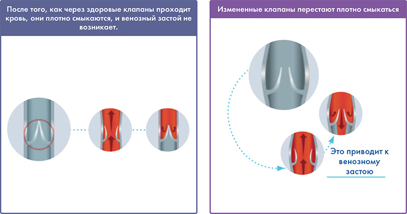 Chronic Venous Disease