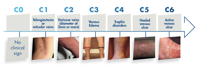 Chronic Venous Disease