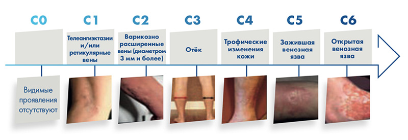 Chronic Venous Disease