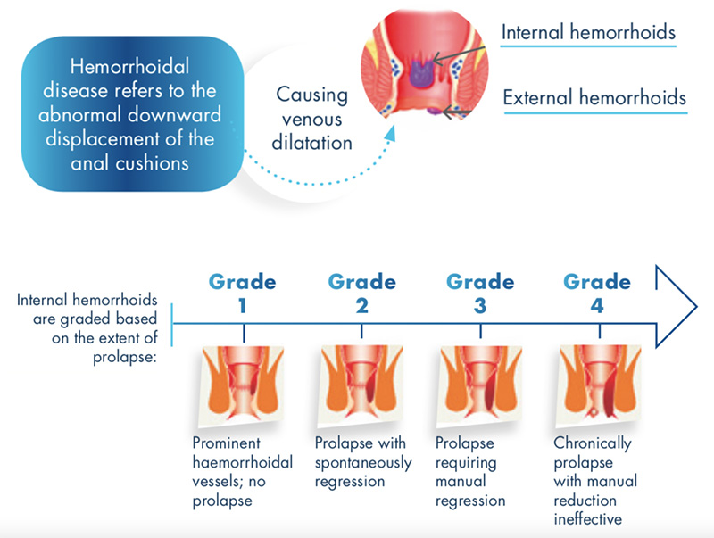 What is hemorrhoidal Disease?