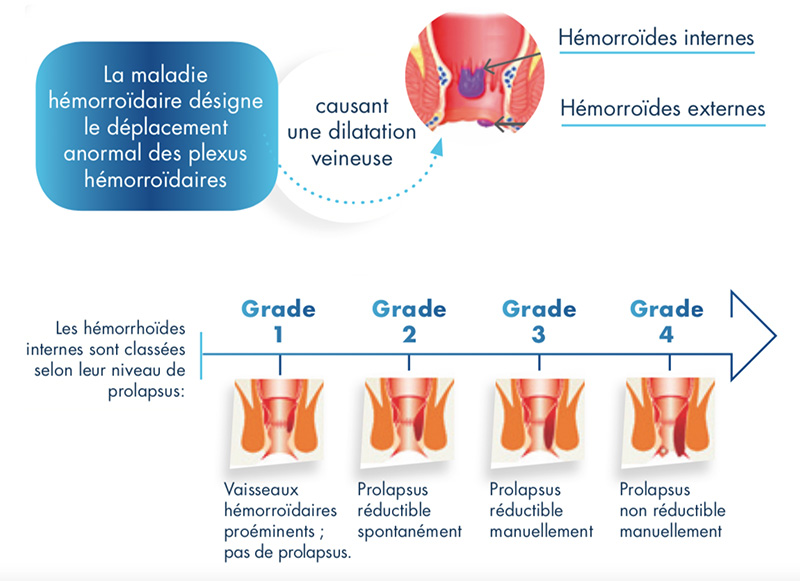 What is hemorrhoidal Disease?