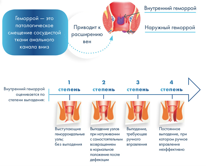 Что такое геморрой?